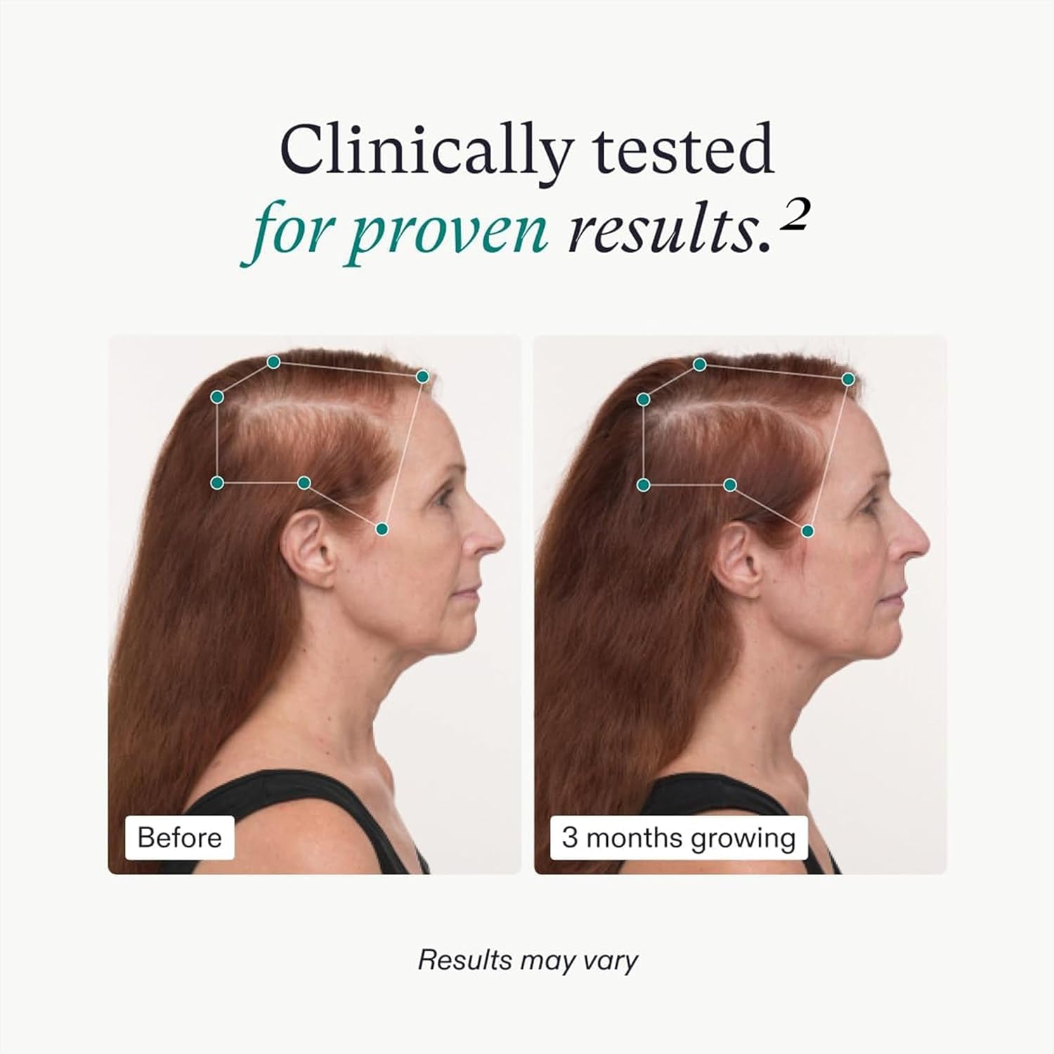 Nutrafol  Women'S Balance Hair Growth Supplements, Ages 45 and Up, Clinically Proven for Visibly Thicker Hair and Scalp Coverage in 3-6 Months, Dermatologist Recommended - 1 Month Supply Refill Pouch