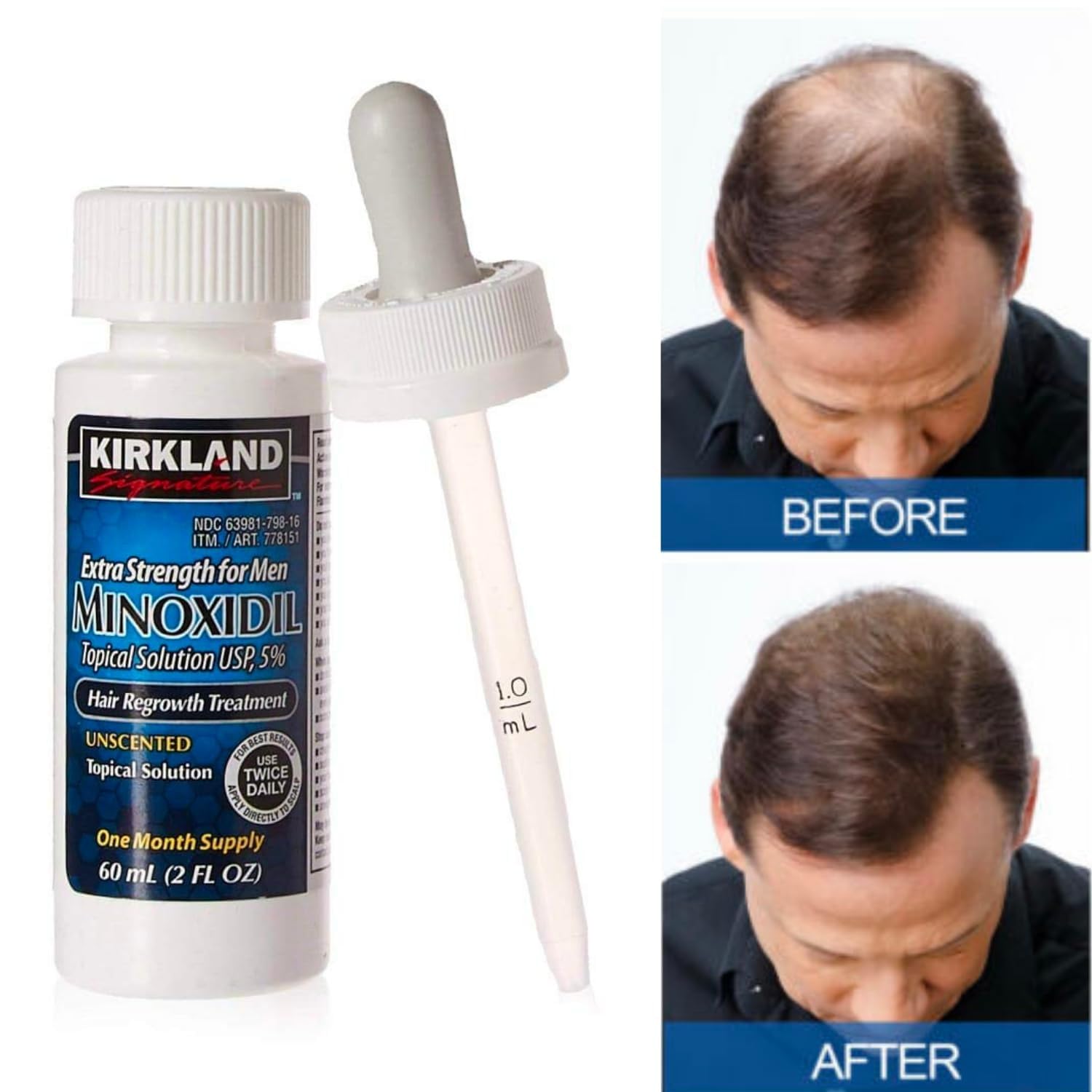 Kirkland Signature Minoxidil 5% Topical Solution for Men - 6 Month Supply (6 X 2 Fl Oz), Hair Regrowth Treatment with Dropper