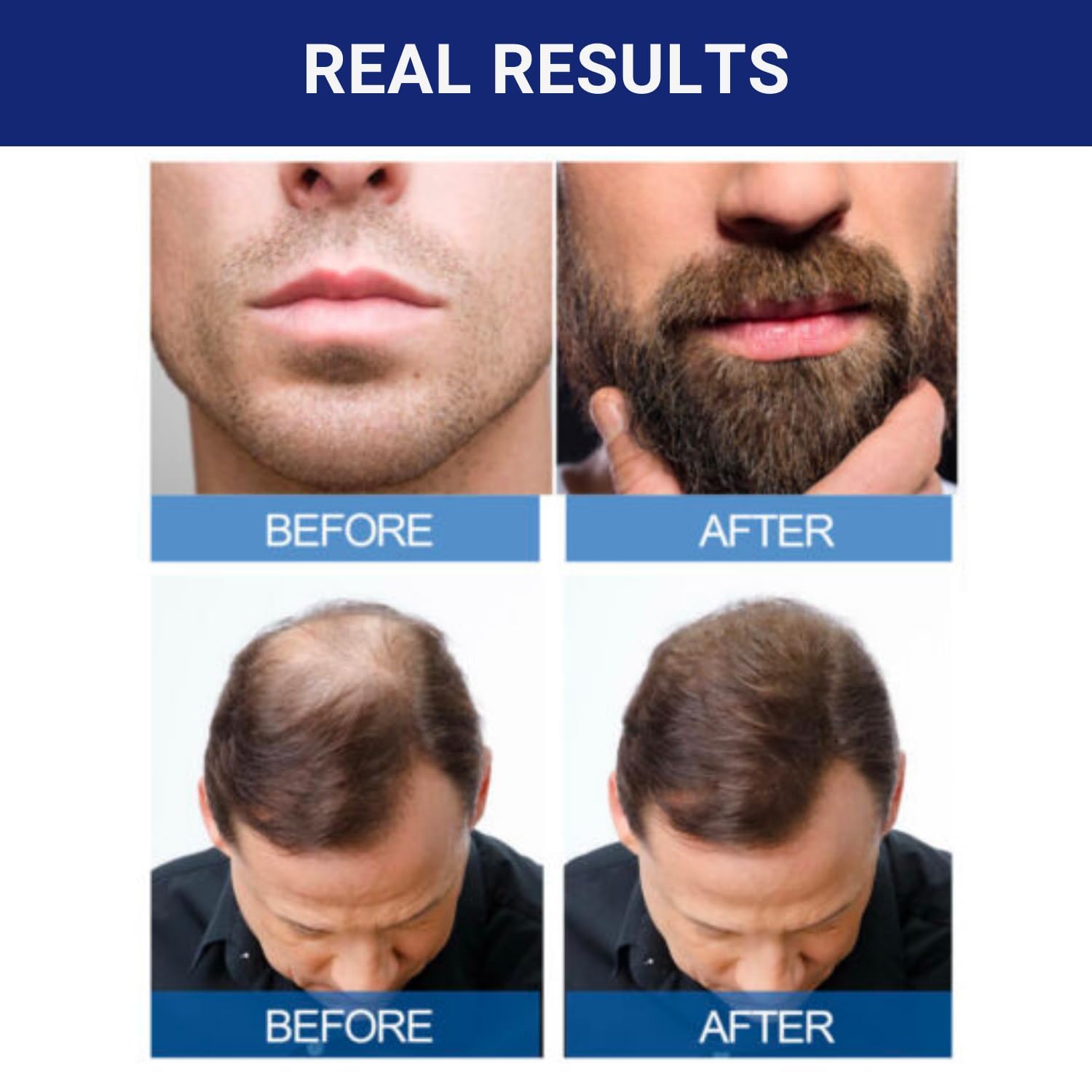 Kirkland Signature Minoxidil 5% Topical Solution for Men - 6 Month Supply (6 X 2 Fl Oz), Hair Regrowth Treatment with Dropper