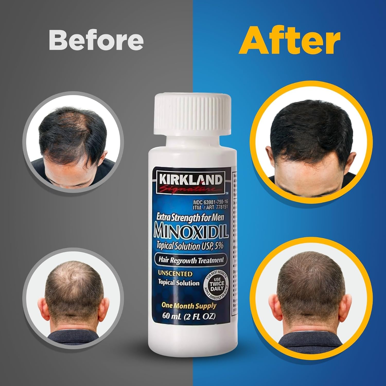 Kirkland Signature Minoxidil 5% Topical Solution for Men - 6 Month Supply (6 X 2 Fl Oz), Hair Regrowth Treatment with Dropper